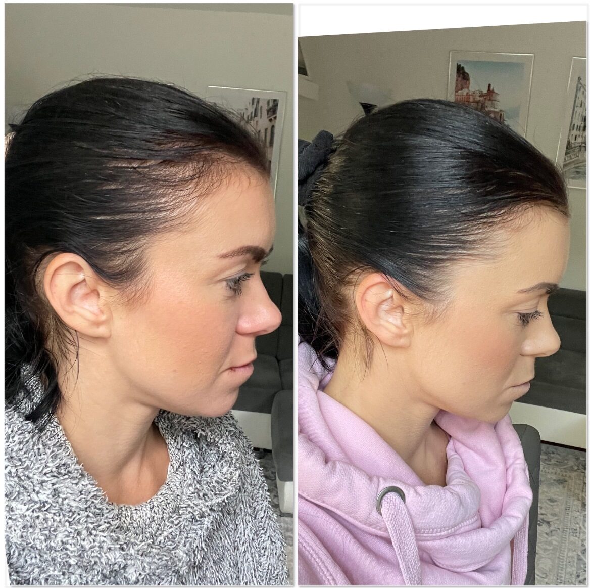 Serenoa Health Wonder Pill for Hair Loss